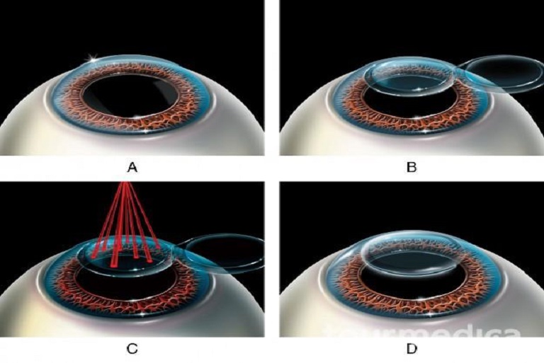 LASIK eye surgery in iran