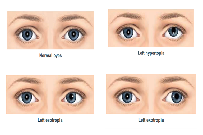 Strabismus Types surgry