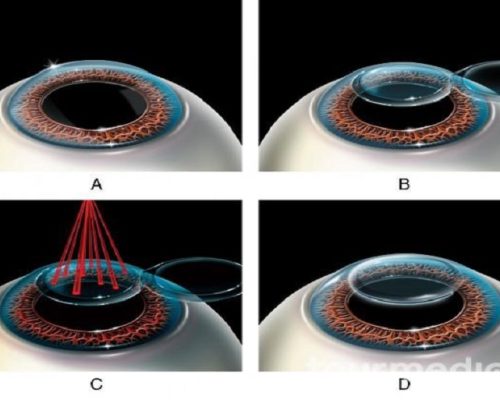 LASIK eye surgery in iran